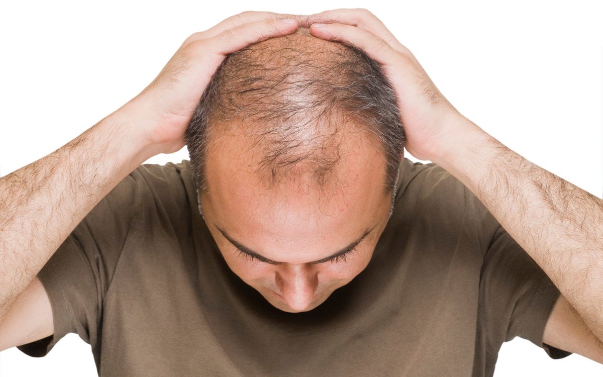 10 روش برای جلوگیری از ریزش مو‌ی آقایان