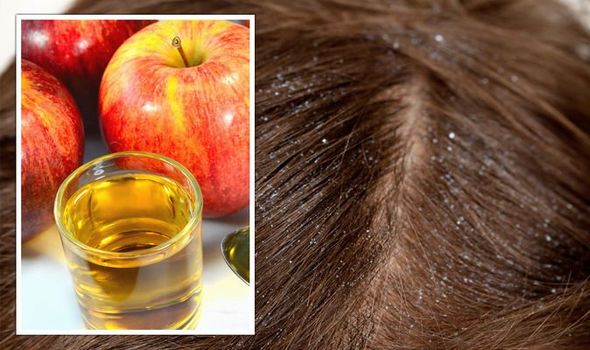 درمان شوره سر با سرکه سیب