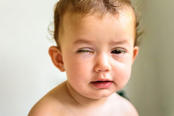درمان خانگی چشم درد در کودکان